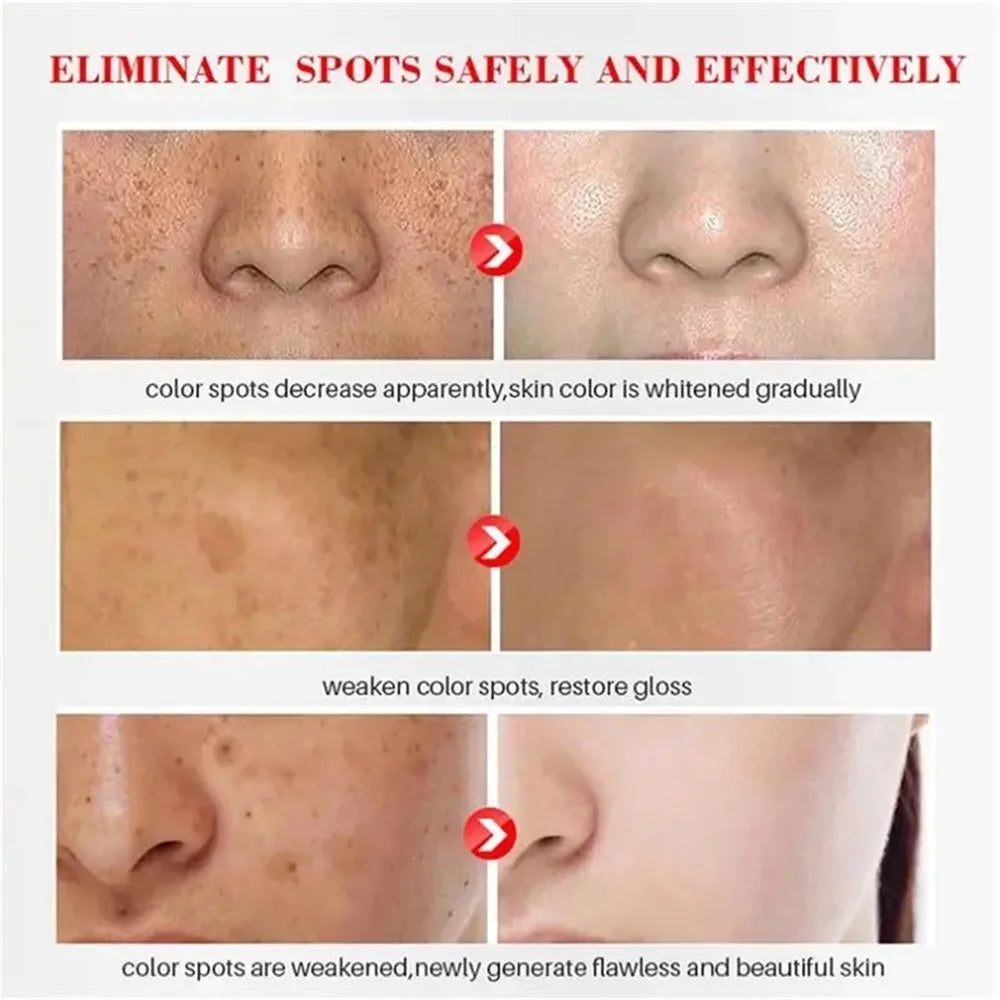 Spot-Removing Whitening Cream - Melasma & Dark Spot Treatment