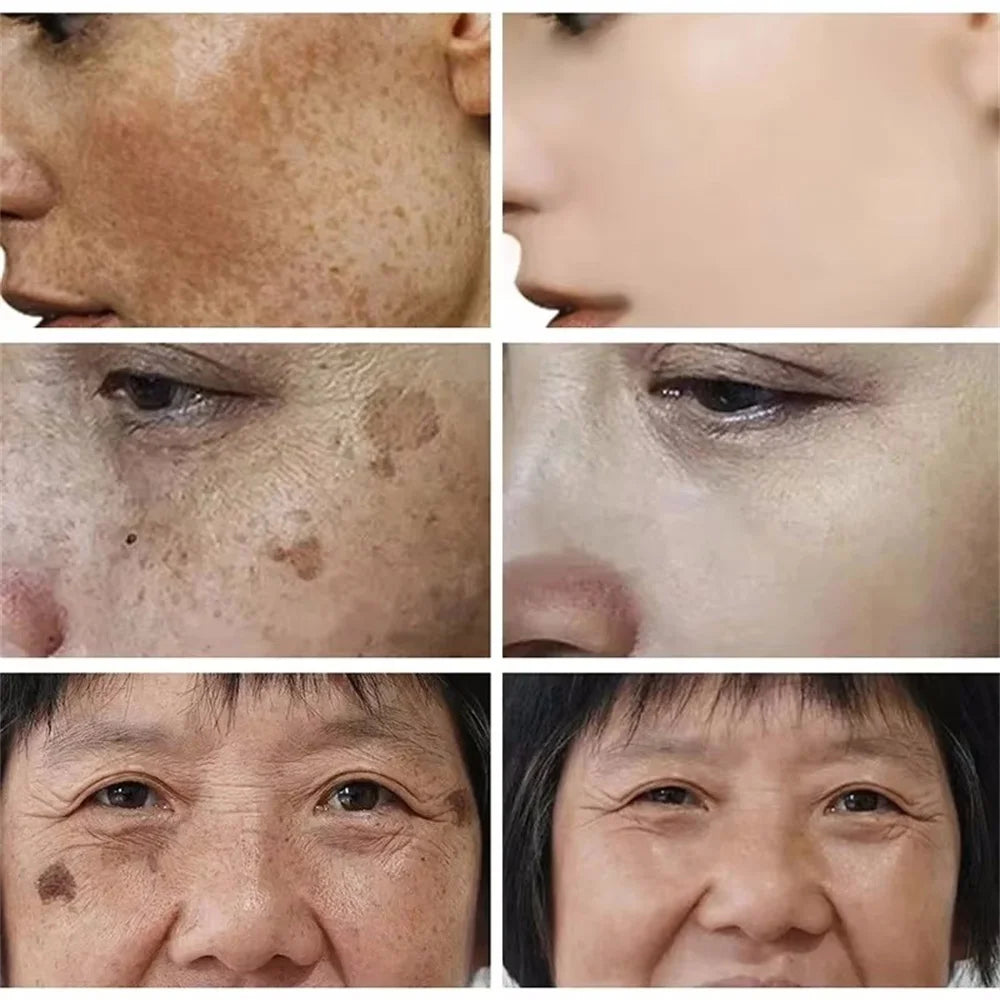 Spot-Removing Whitening Cream - Melasma & Dark Spot Treatment