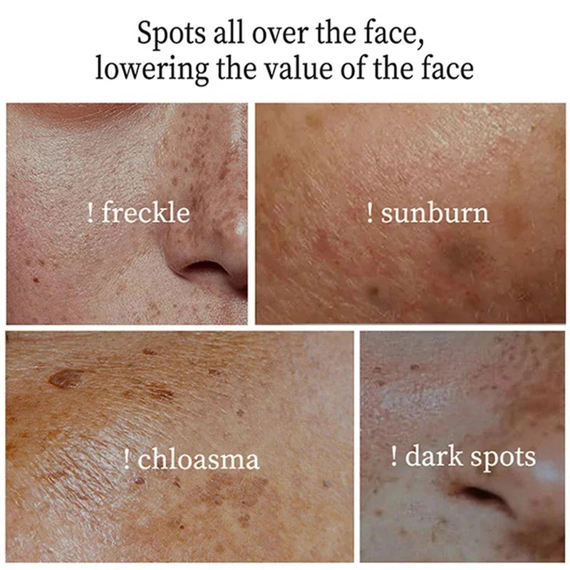Spot-Removing Whitening Cream - Melasma & Dark Spot Treatment